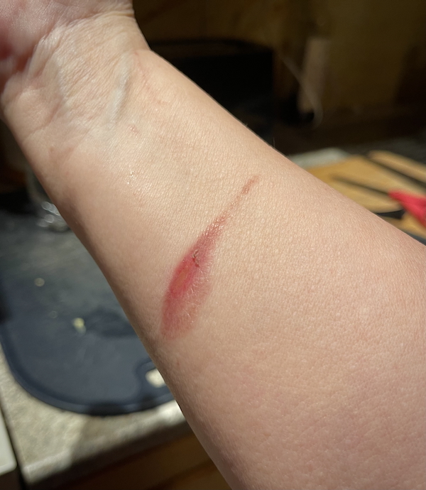 Joulukuun valoja ja varjoja. Kuvassa käsivarsi jossa pieni palovamma.